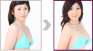 豊胸術 胸を大きく バストアップ/「バストバッグ(人工乳腺)法」の術前・術後